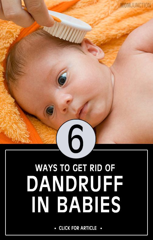 6 Ways To Get Rid Of Dandruff In Babies