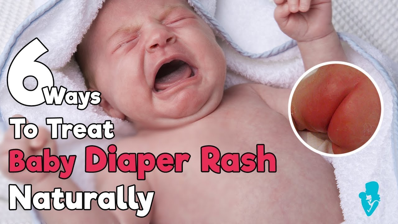 6 Ways To Treat Baby Diaper Rash Naturally