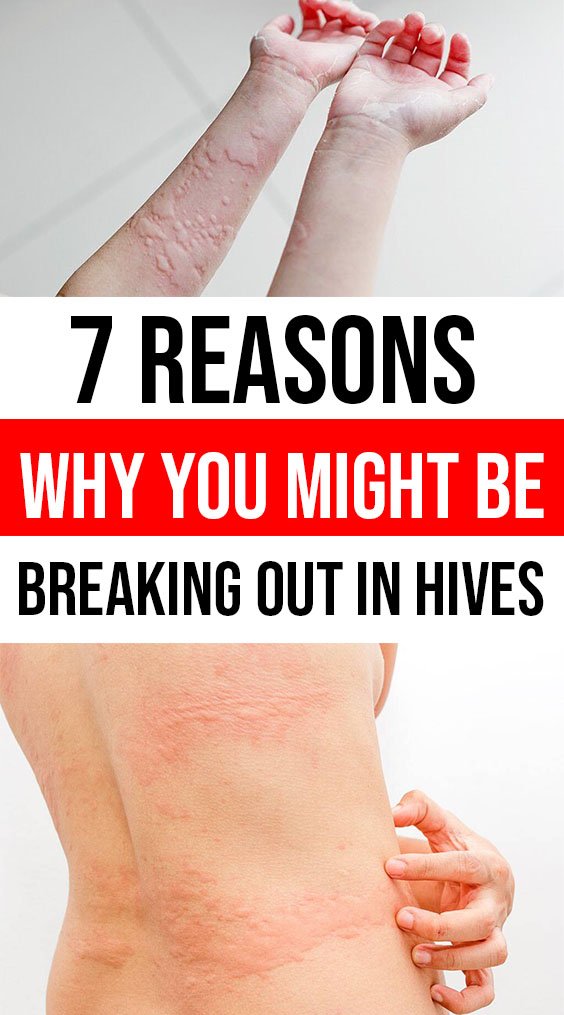 7 Reasons Why You Might Be Breaking Out in Hives