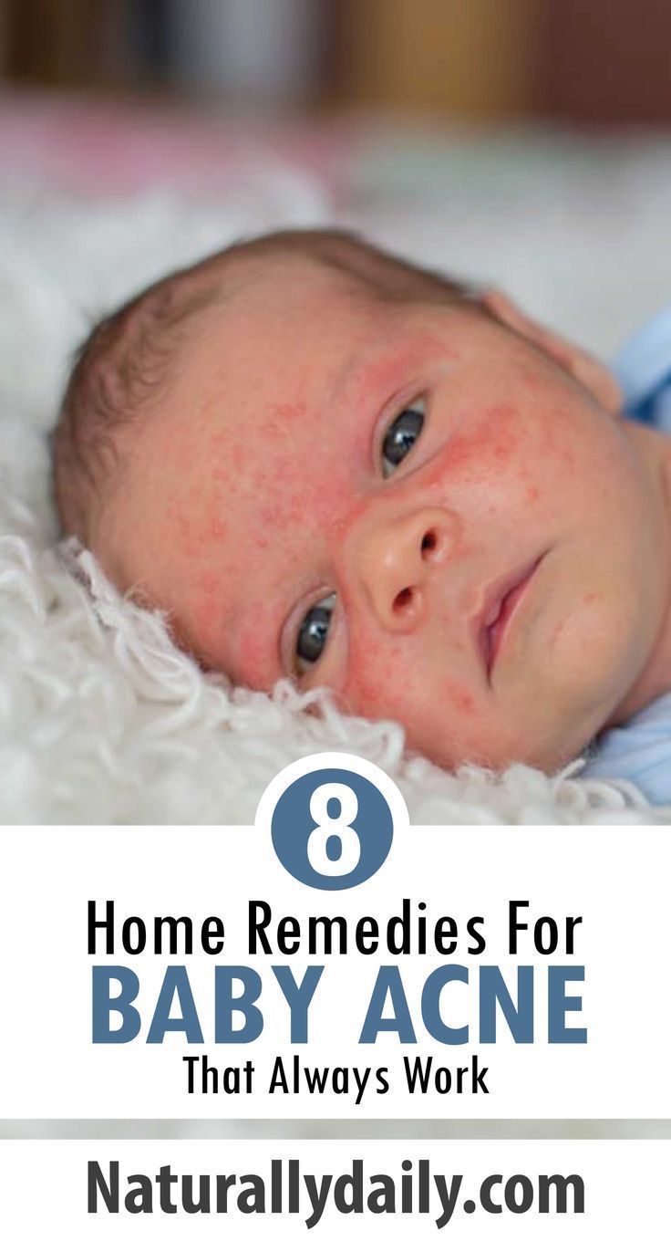 8 Safe Home Remedies for Baby Acne #babyrashestreatment Baby acne is ...