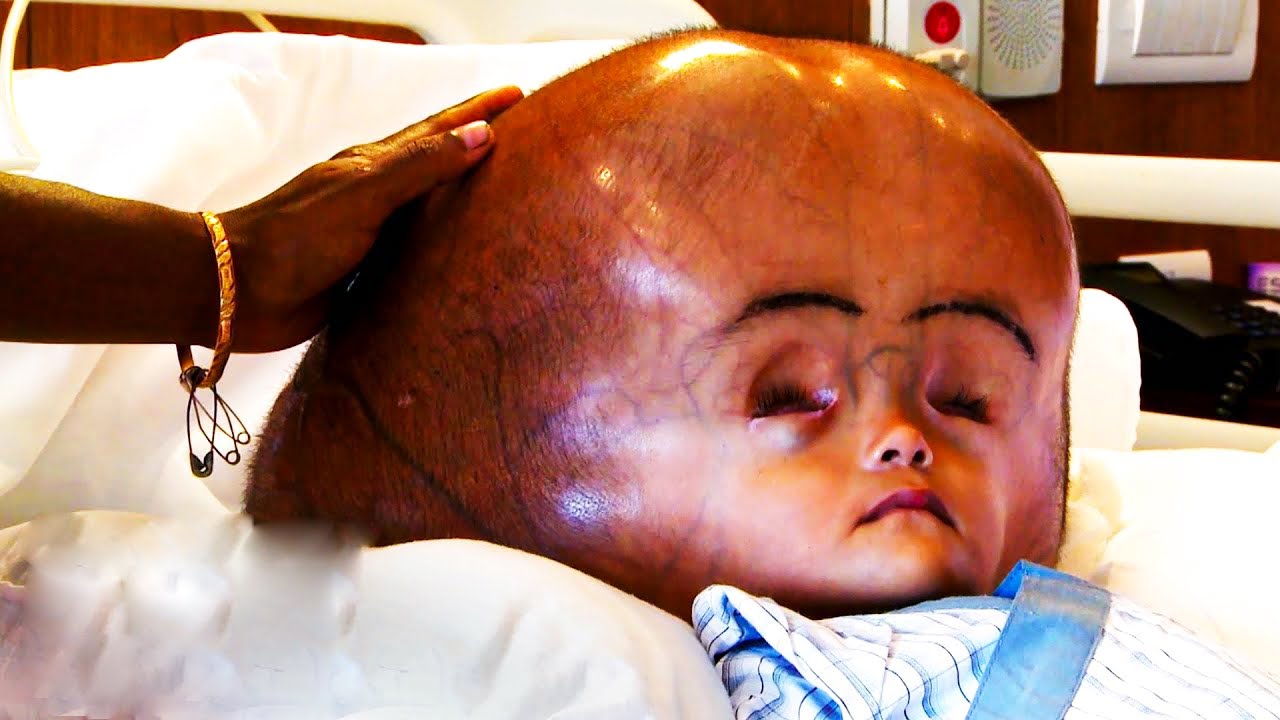 A Baby Boy Was Born With An Abnormally Long Head Then The Doctor Gave ...