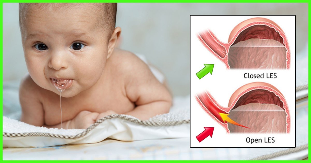 Acid Reflux In Babies: Causes, Symptoms And Treatment ...
