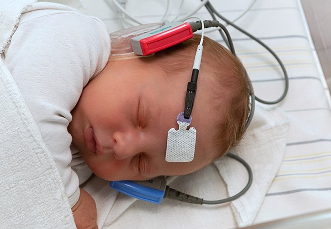 ALGO Newborn Hearing Screeners