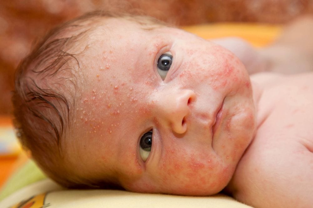 Baby Acne: 7 Proven Ways to Treat It