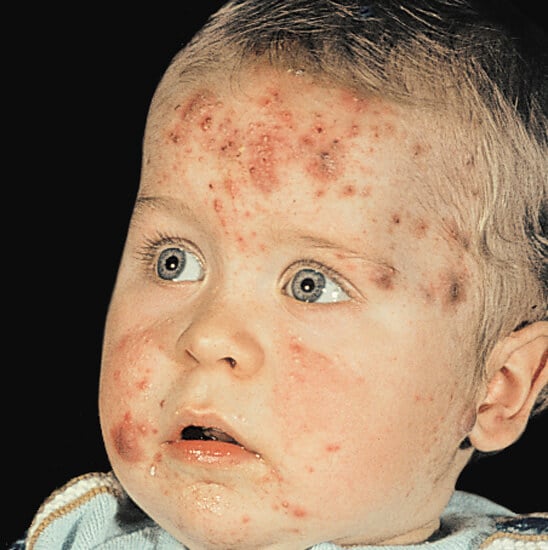 Baby Acne Causes Treatment and Prevention