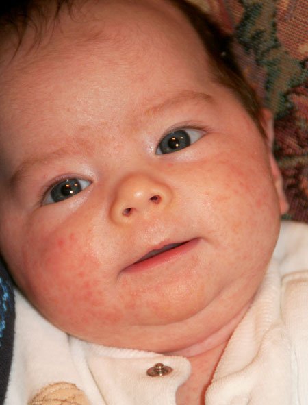 Baby Acne Cure and Treatment: Tips to Prevent Baby Heat ...