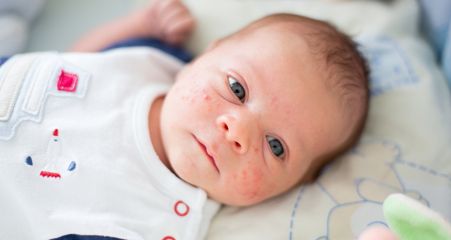Baby Acne: How to Get Rid of Baby Pimples