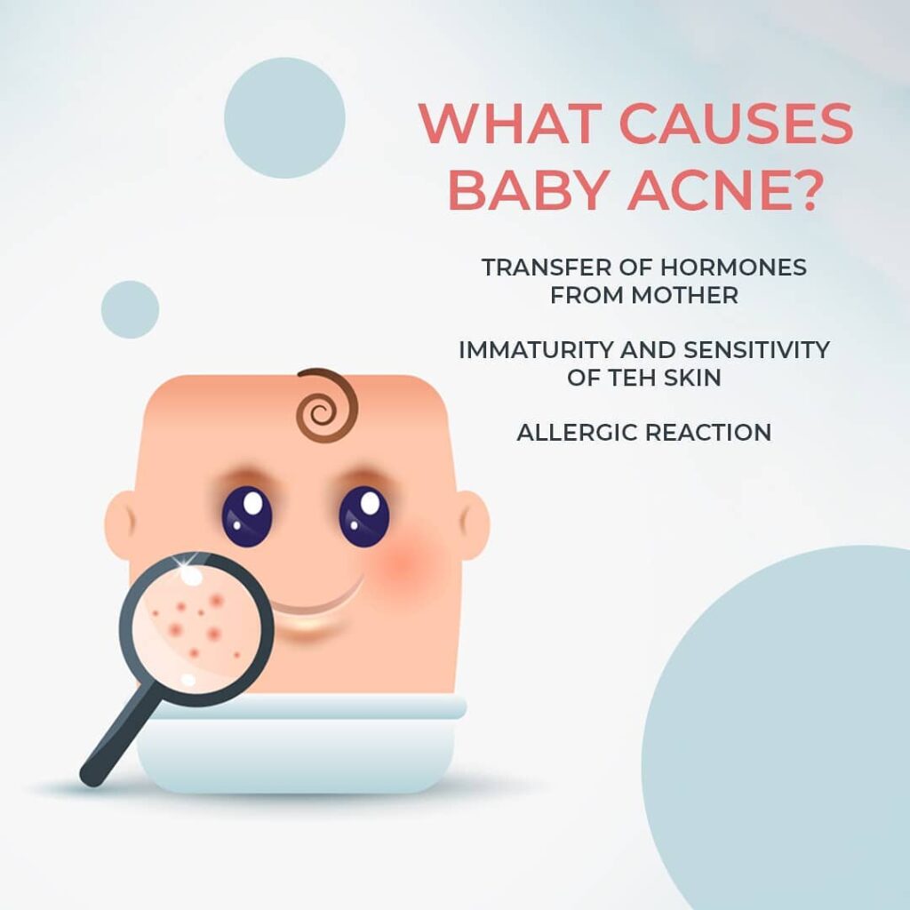 Baby acne remedies