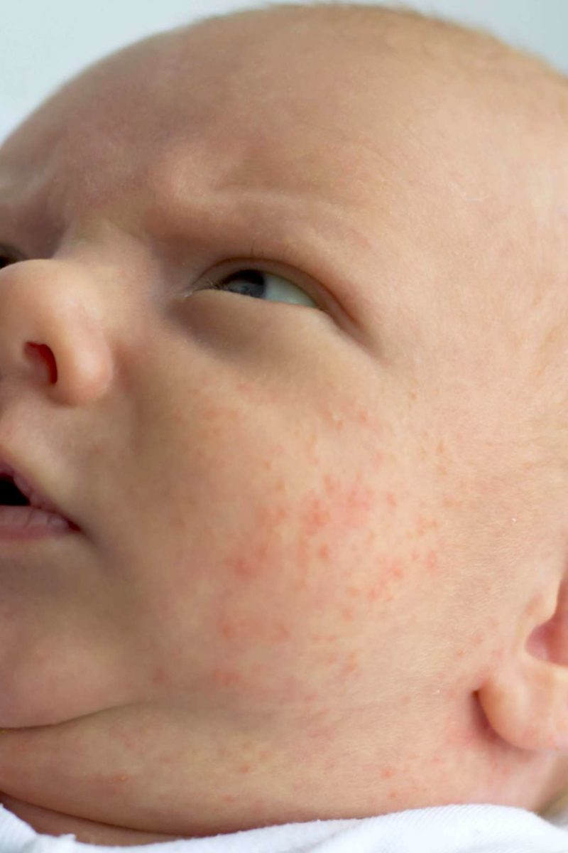 Baby acne vs. eczema: How to tell the difference