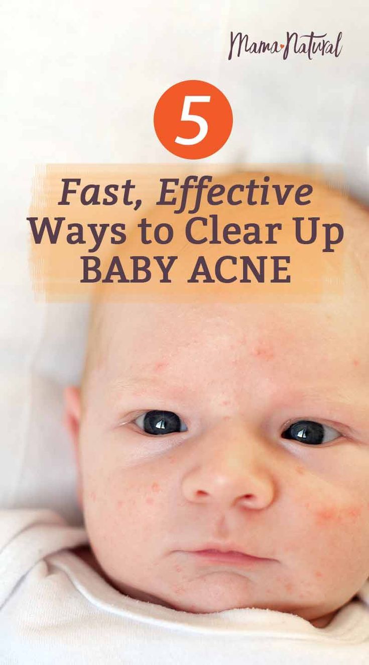 Baby Acne: What Causes It &  How to Treat Naturally