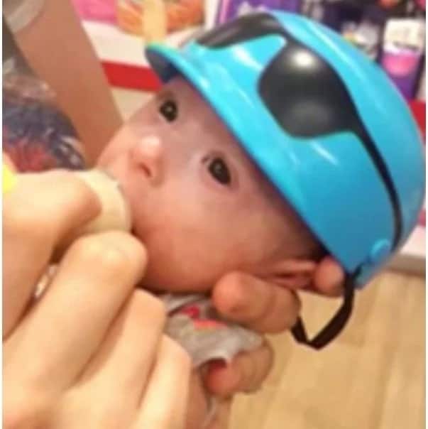 Baby Born With Dwarfism Looks Like A Premature Newborn, But His Real ...