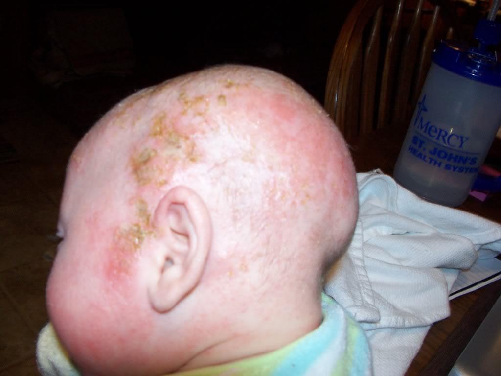 Baby Cradle Cap Pictures Symptoms Causes And Treatments