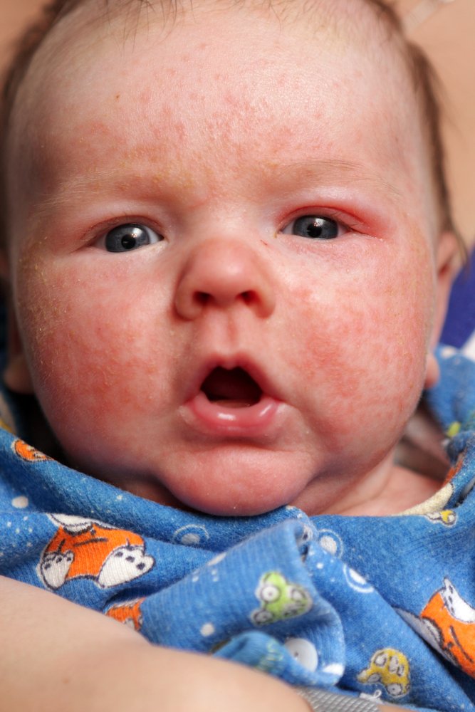 Baby Eczema Treatment on the NHS: A Parentâs Guide