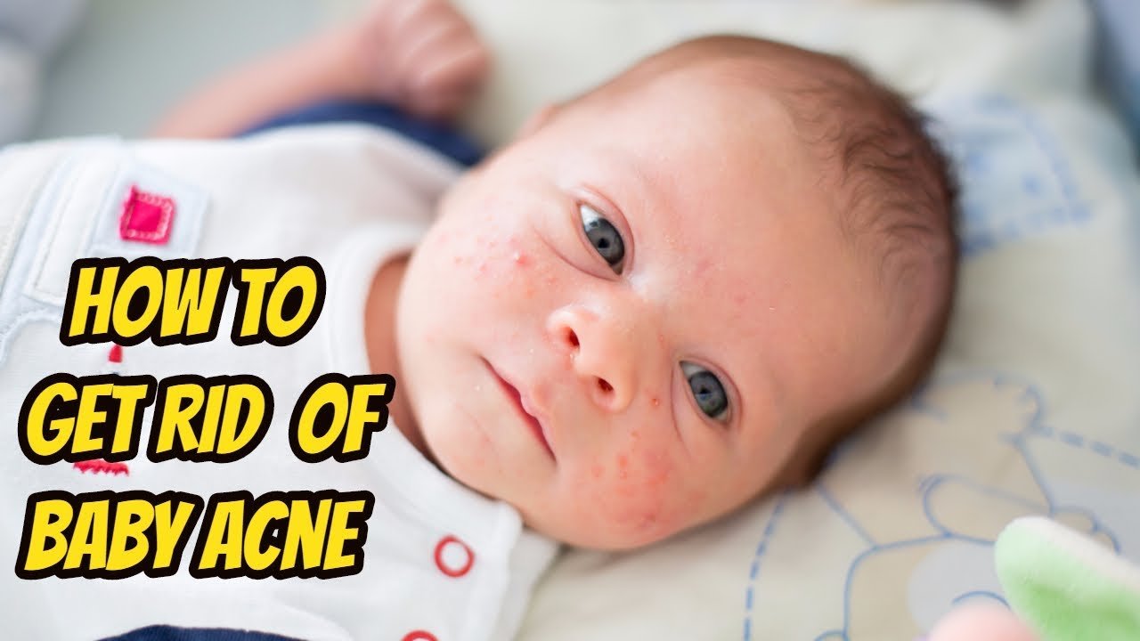 Best Way How to Get Rid Of Baby Acne on Face in Newborn ...