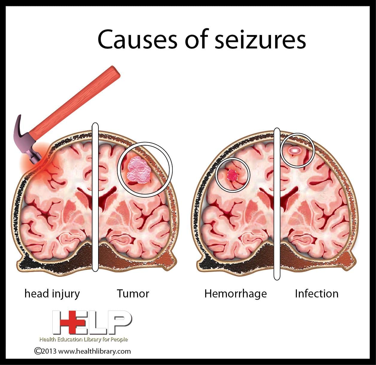 Causes of Seizures
