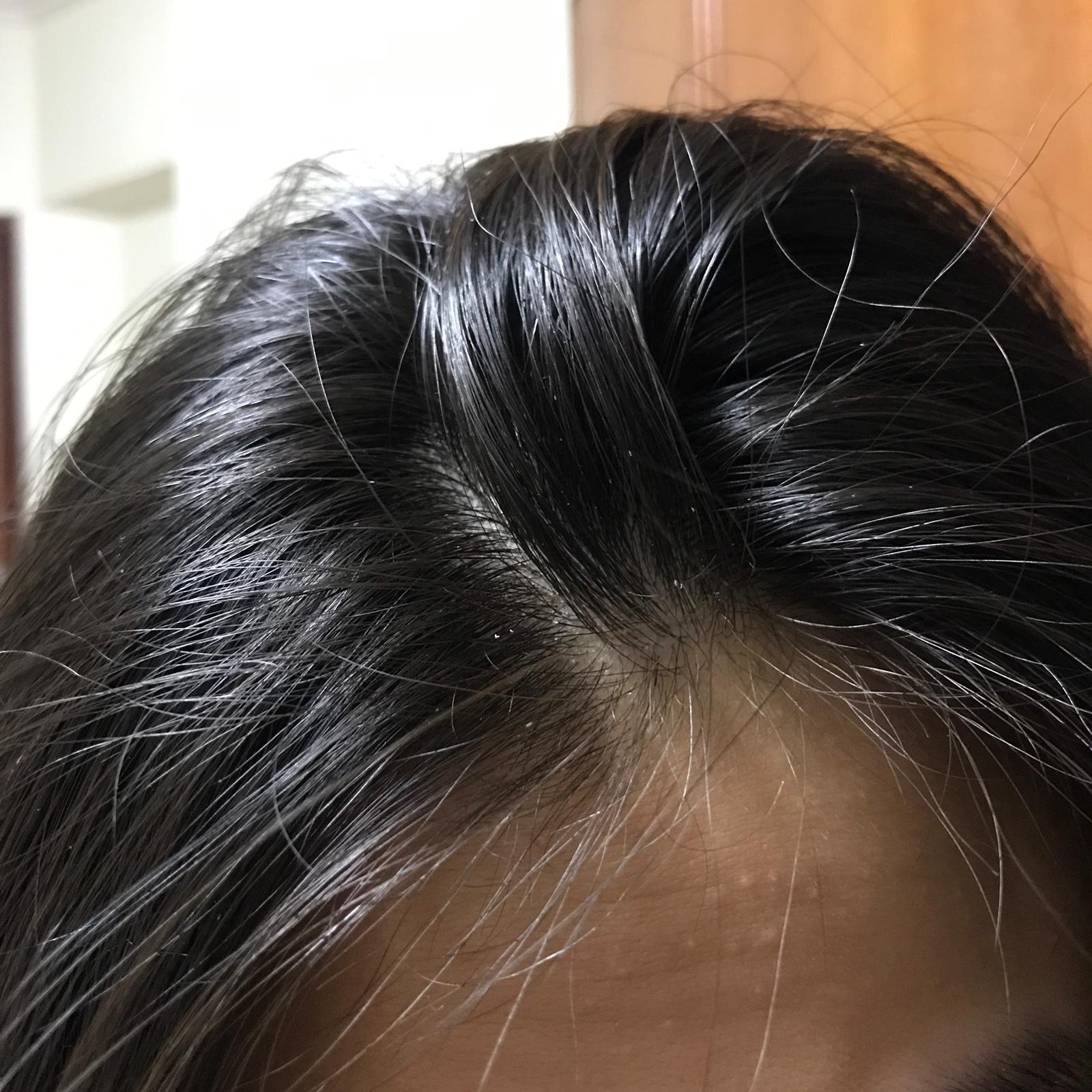 Dandruff or dry scalp? (Will write in more details below ...