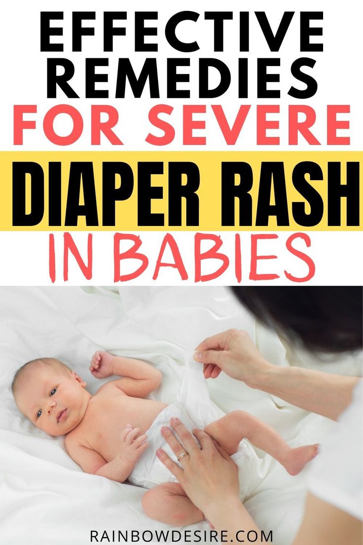 Diaper rash in babies and toddlers #babies #Diaper #Rash #Toddlers ...