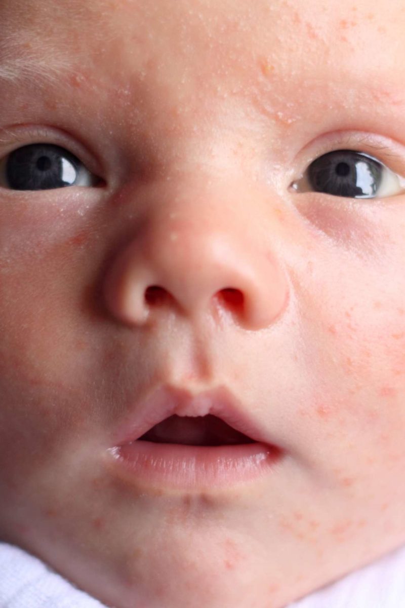 Does my baby have acne or a rash? Diagnosis and treatment