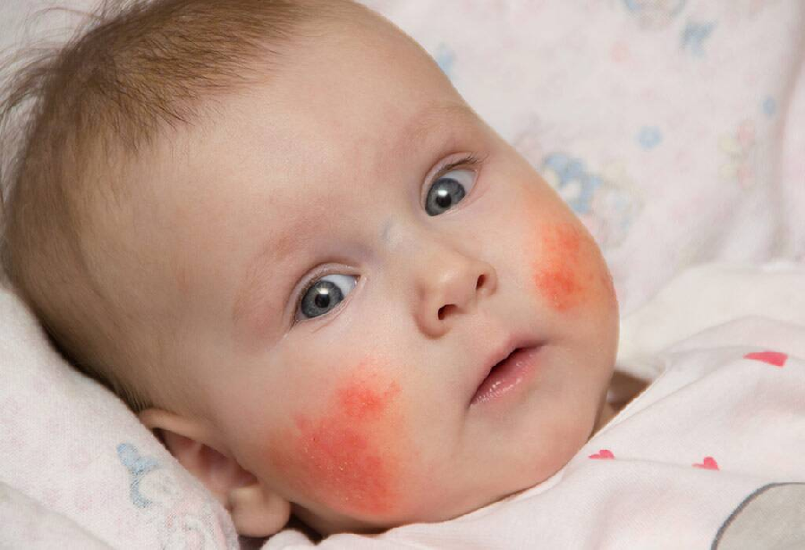 Does My Baby Have Eczema?