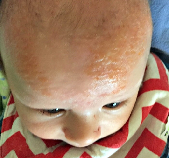 Eczema on Babies: What We did for my Infant