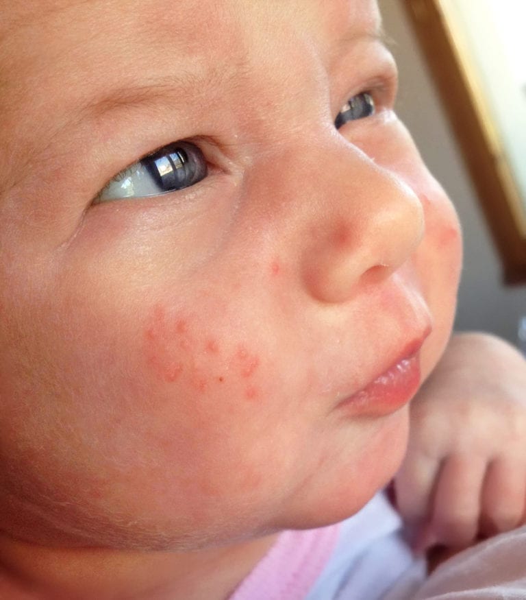 Eczema or Infant Acne? How To Tell The Difference