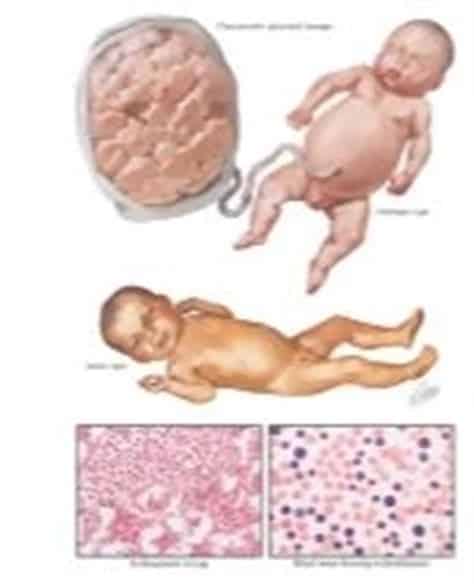 Erythroblastosis fetalis symptoms