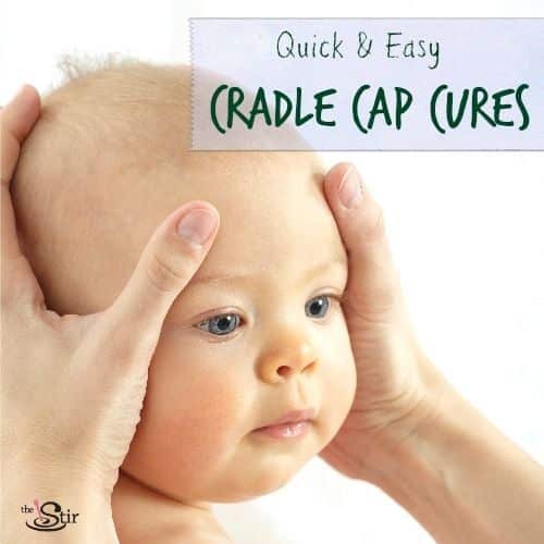 Get Rid of Horrible Cradle Cap the Natural Way  BabyCare Mag