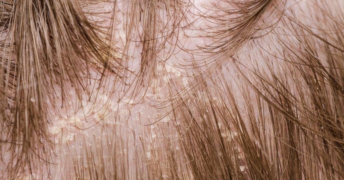Get Rid Of That Dry Scalp With These 10 Simple Home Remedies