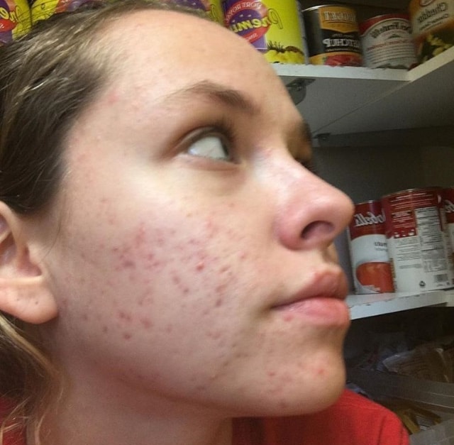 Help, my acne wont go away and my scars are horrible ...