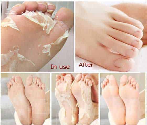 Here is a basic homemade recipe for removing dead and dry skin from ...