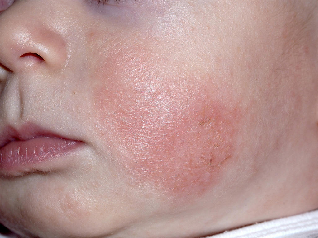 How do I know if my baby has eczema?