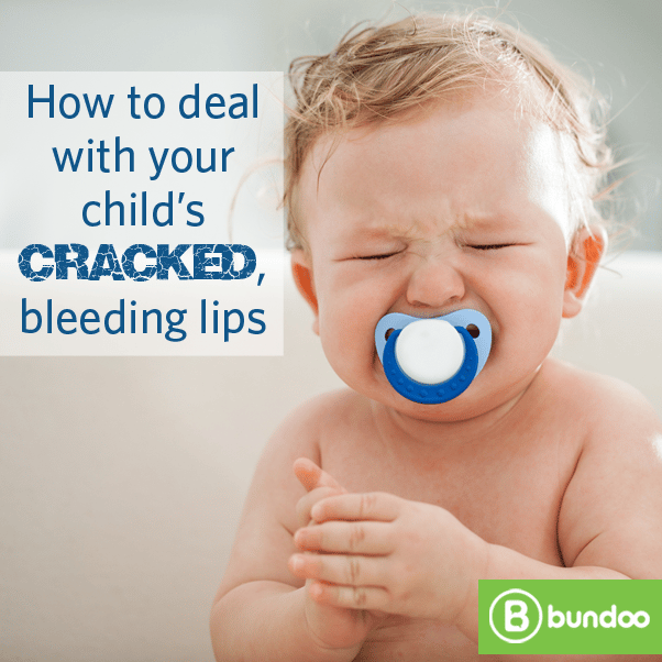 How to deal with your childâs cracked, bleeding lips