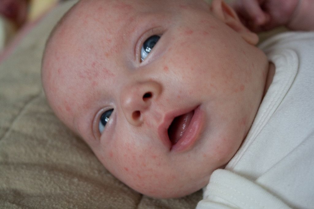 How To Get Rid of Baby Acne: When Baby Doesnt Have Baby ...