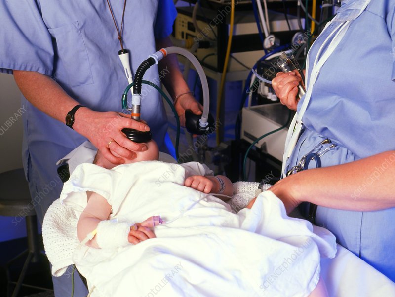 Infant having anaesthetic pre cardiac catheter.