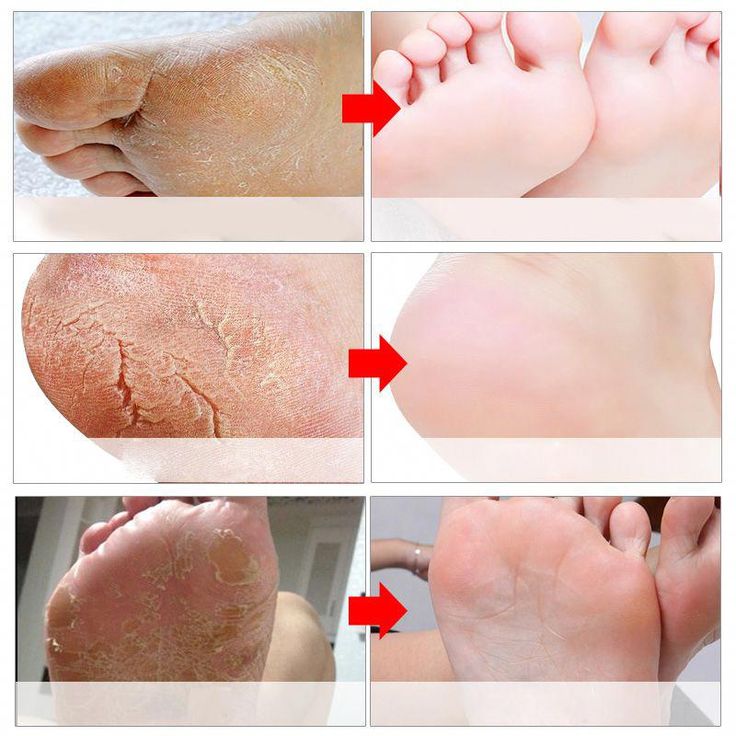 mask for removing dead and dry skin from feet. This will peel off and ...