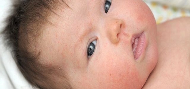 Mild Eczema On Baby Face Treatment