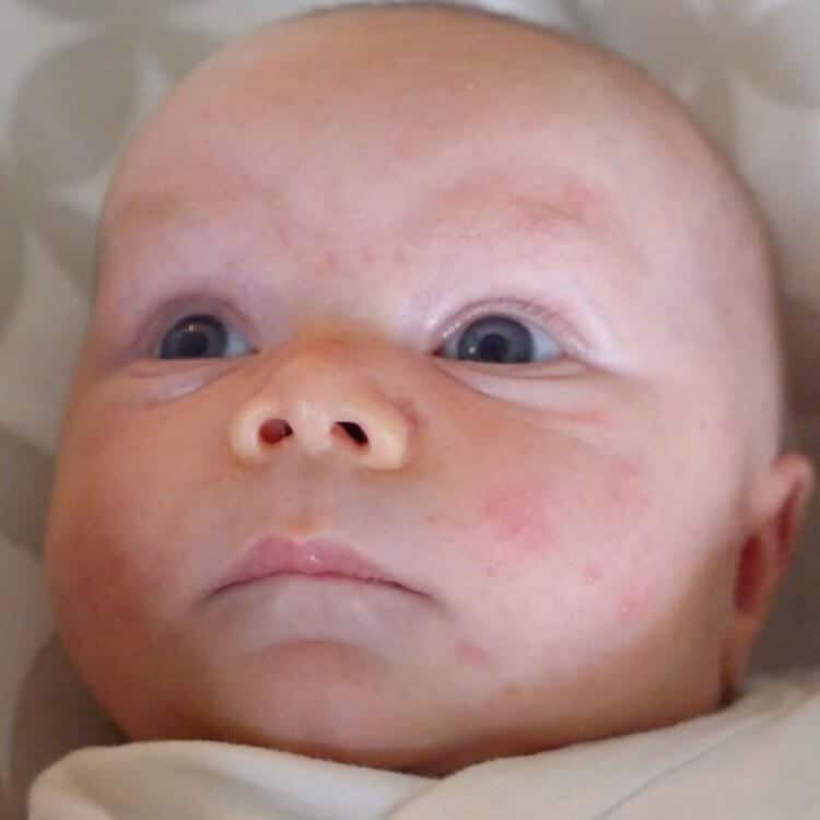 Milenium Home Tips: Baby Acne On Eyelids