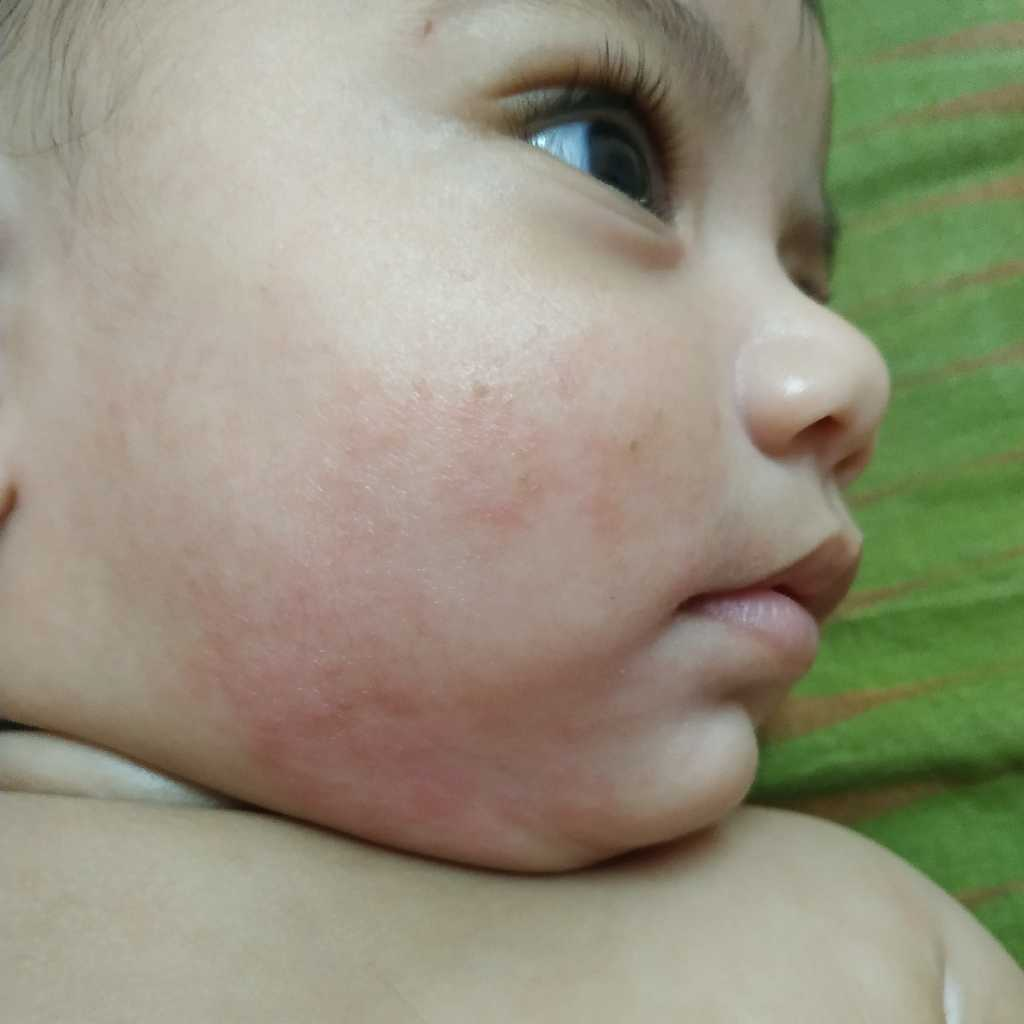 My baby had heat rash on her stomach. Now its gone. Bt her ...