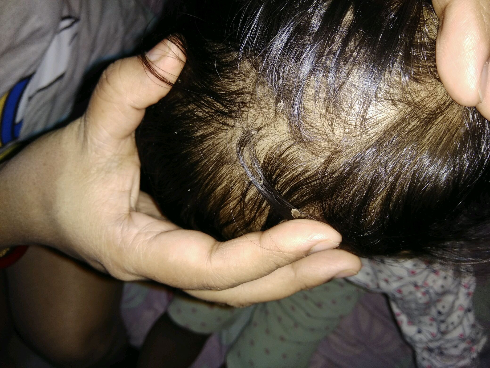 My baby is feeling itchy scalp and layer of skin scales oozes out.