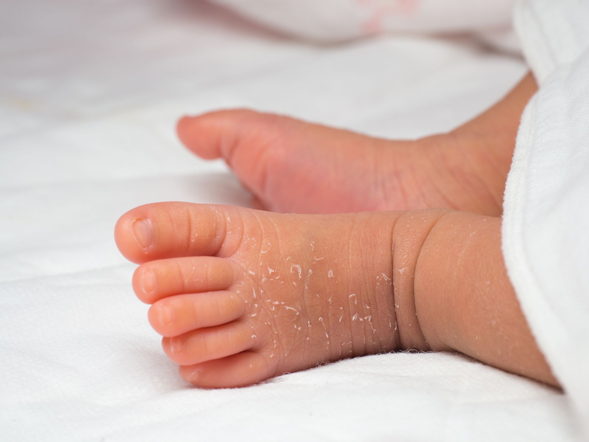 Newborn Skin Peeling: Causes and Treatment
