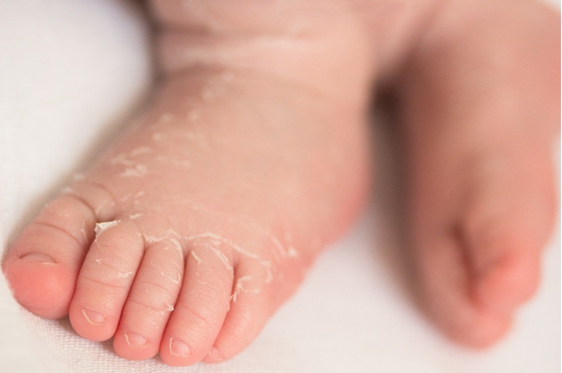 Newborn Skin Peeling: Causes &  Treatment