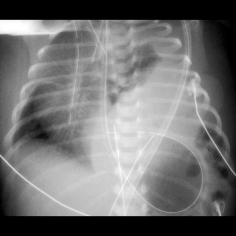 Newborn with a left congenital diaphragmatic hernia on arterial