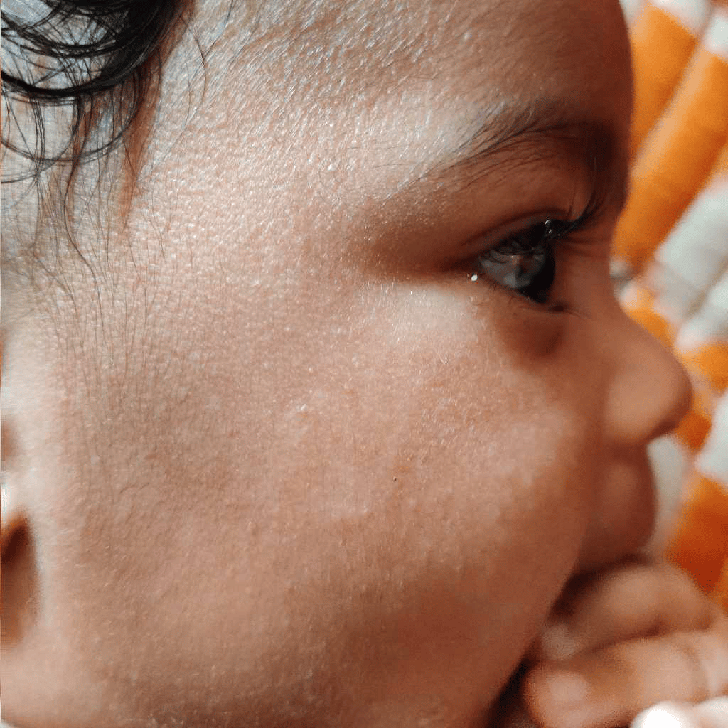 #ParentingClinic #BabySkinCare my baby is having small pimples in her ...