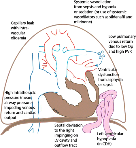 Persistent pulmonary hypertension of the newborn