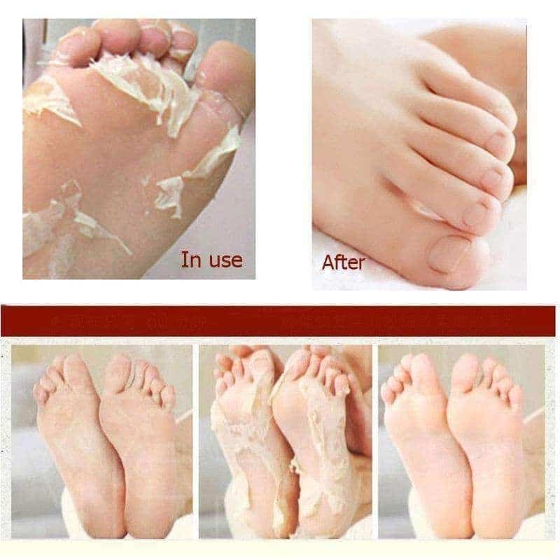 Remove Dead Skin Cuticles Heel Foot