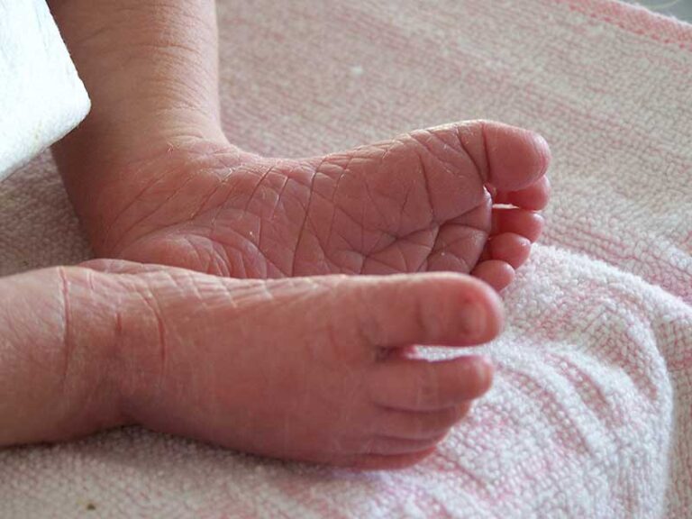 Skin Peeling on Your Newborn Baby? How to Help Their Dry Skin