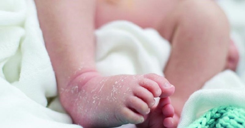 The Common Skin Conditions in Newborns