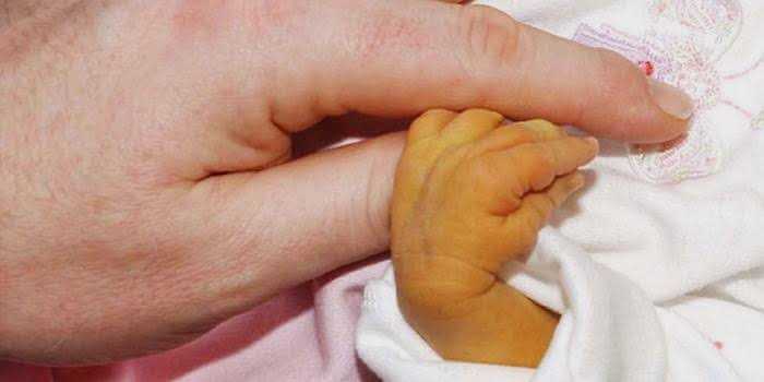 Things to know about NEONATAL JAUNDICE