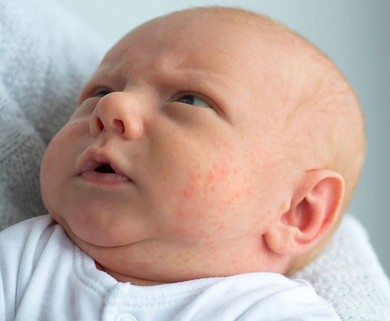Understanding baby acne