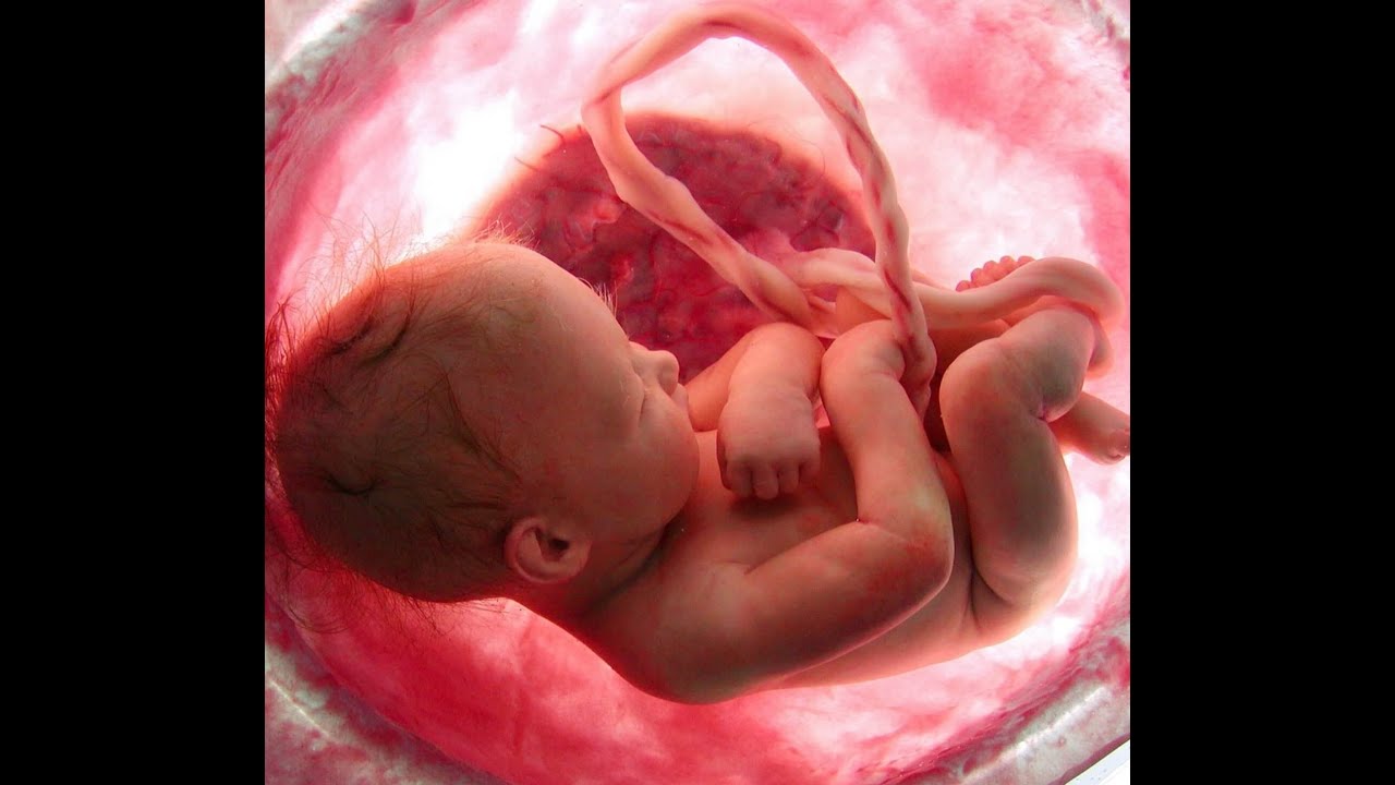 Understanding complex fetal echo: Hypoplastic Left Heart ...